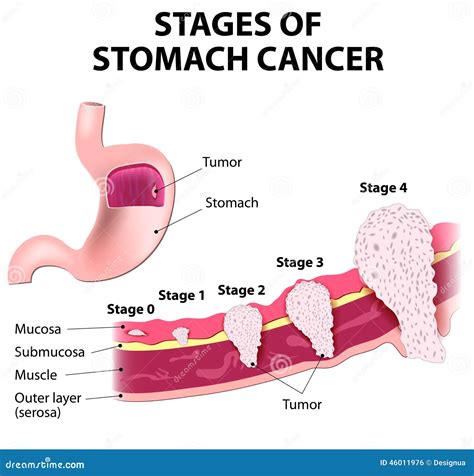 Causes Of Stage 4 Stomach Cancer - jualitapomsiblog