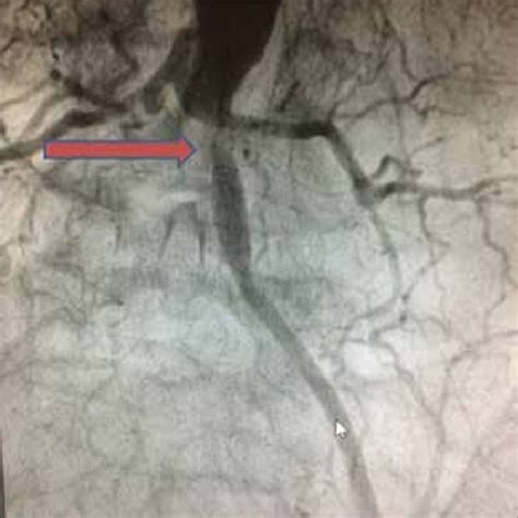 Conventional Angiography Showing Right Iliac Artery Occlusion And Left Download Scientific