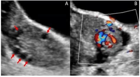 A Us Findings Showing Enlarged Left Ovary 1851cm 3 Normal Reference