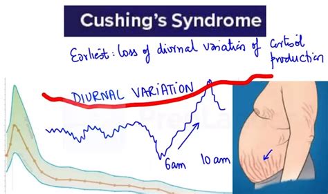 Cushing Syndrome Causes Clinical Features Diagnosis And More