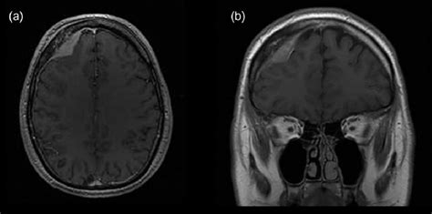 Initial Brain Mri Showing Extra Axial Mass In The Right Frontal Part Of