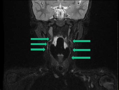 Branchial Cleft Cyst Diagram