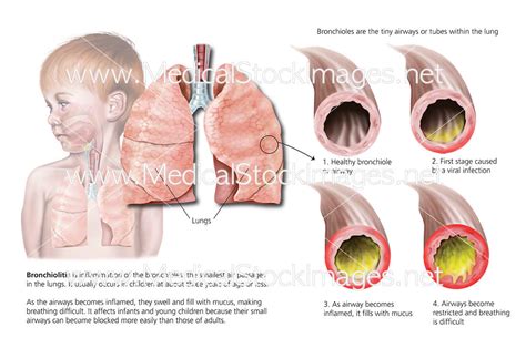 Bronchiolitis in Child showing Inflammation of the Bronchioles – Medical Stock Images Company