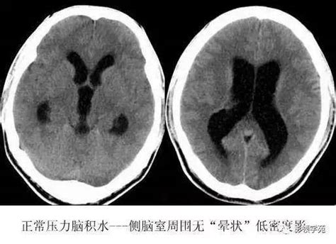 一文看懂 ：脑积水的病因及鉴别脑室