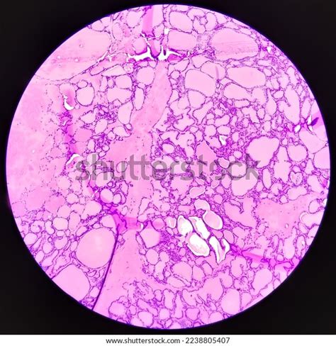 Synovial Sarcoma Histology Image Analyzed By Stock Photo 2238805407 ...