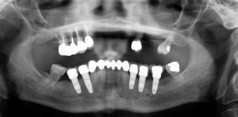 DENTAL IMPLANT PROBLEMS-WHAT OUR EXPERTS SAYS ABOUT DE