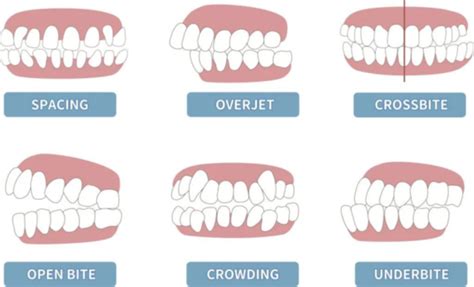 Braces Aurora Co Straighten Crooked Teeth Teeth Braces