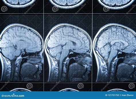 X Ray Of The Head And Brain Mri Stock Photo Image Of Anatomy