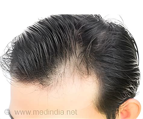 Softening Stem Cells Enhances Hair Growth Potential