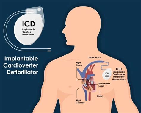 Implantable Cardioverter Defibrillator Icd