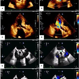 Transthoracic And Transesophageal Echocardiography Transthoracic AD