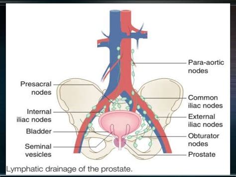 Prostate Cancer Radiotherapy