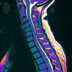 Irm Du Rachis Cervical D Finition D Roulement Prise De Rdv En Ligne