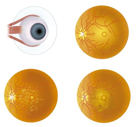 Vitelliform Macular Dystrophy Causes Treatment And More