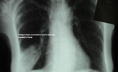 Respiratory Emergency Medicine Flashcards Quizlet