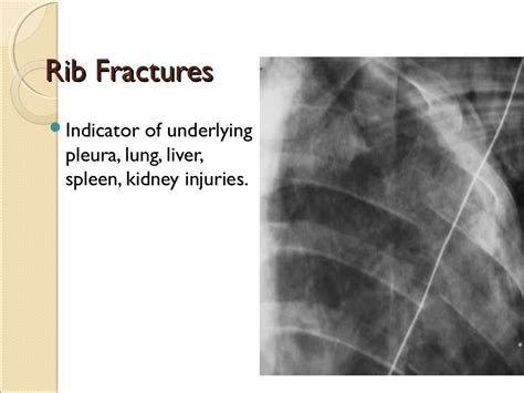 Imaging Chest Trauma