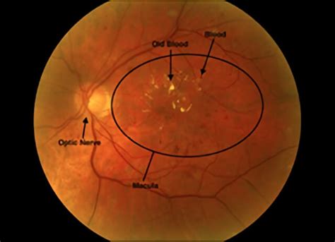 Diabetic Macular Edema Care Retinal Consultants Medical Group