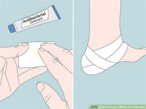 3 Easy Ways To Treat A Blister On Your Heel WikiHow