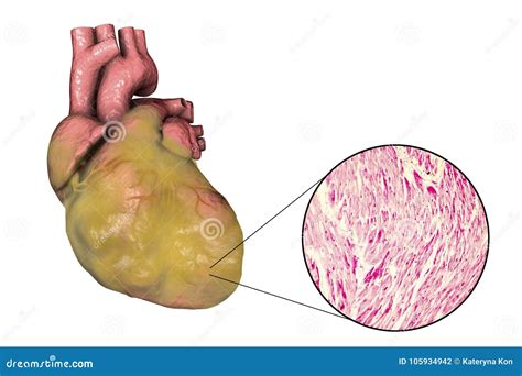 Obese Heart Illustration Stock Illustration Illustration Of Concept 105934942