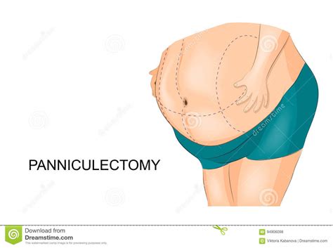 Retrait De Gros Tablier Panniculectomy Illustration De Vecteur