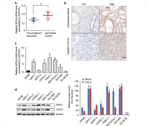 Brd Is Overexpressed In Pc A Compared To Adjacent Normal Tissues