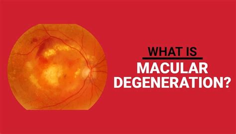 Explanation On Age Related Macular Degeneration Age R