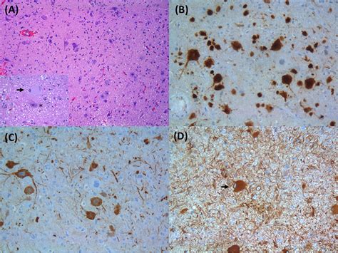 Frontiers Genomic And Epigenetic Advances In Focal Cortical Dysplasia