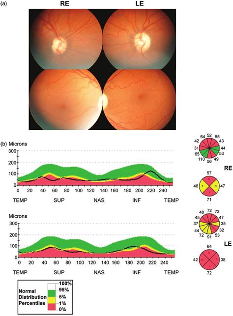 A Fundus Photographs Depicting Optic Disc Pallor B Time Domain