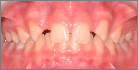 Scielo Brazil Agenesis Of Maxillary Lateral Incisors Diagnosis And