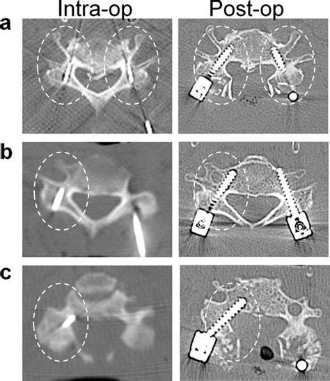 A Intraoperative Intra Op Ct Images Were Obtained To Confirm Whether