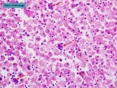 Qiao S Pathology Cytological Features Of Peritoneal Endometriosis A