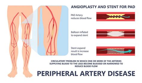 Angioplasty Vascular Stent Treatment Fairfax Vascular Center