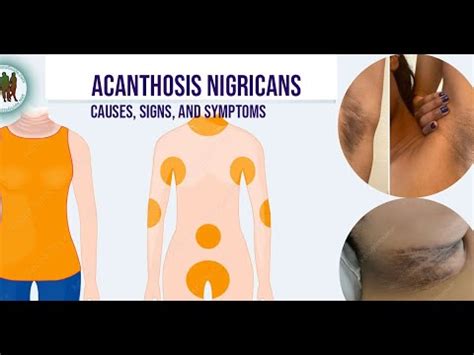 Acanthosis Nigricans Causes Signs And Symptoms Youtube