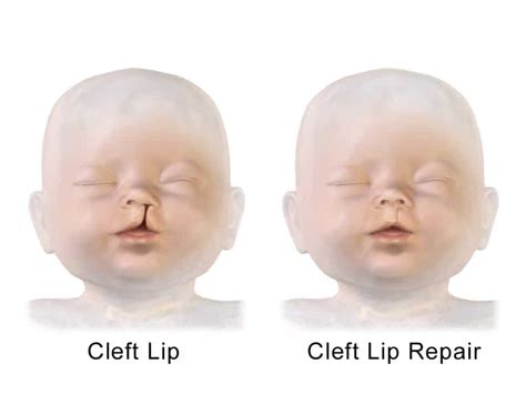 Is Cleft Lip Genetic Decode Your Dna And Learn About Your Risks