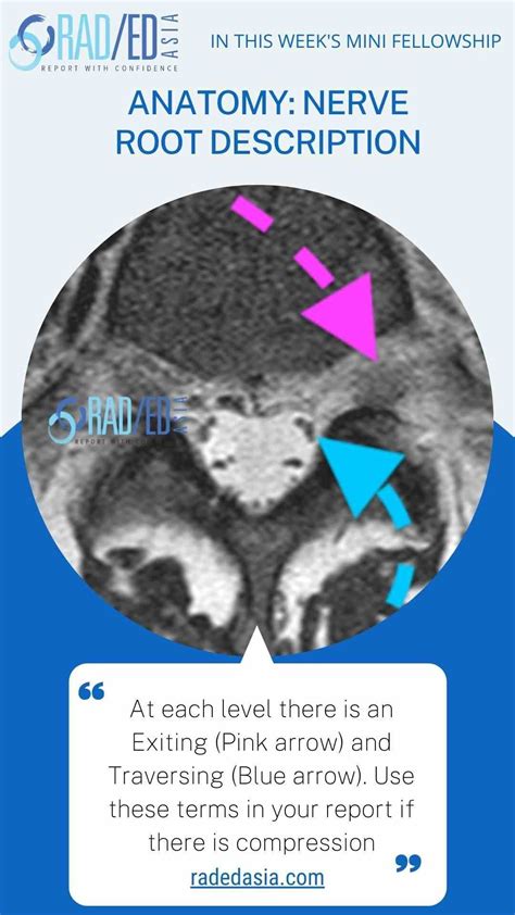 SPINE MRI ONLINE RADIOLOGY COURSE NERVE ROOTS KEY POINTS FROM OUR