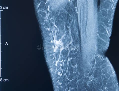 Knee injury mri mcl tear stock image. Image of magnetic - 154117375