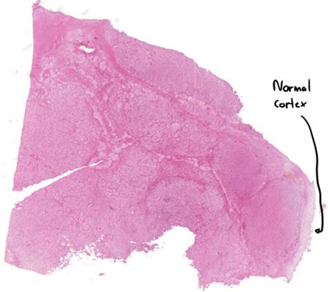 Histology Microanatomy Of Adrenal Gland Suprarenal Gland Youtube Hot