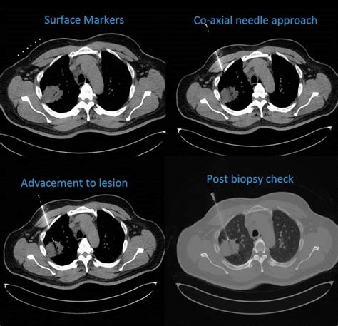 Ct Guided Thoracic Biopsy Pacs