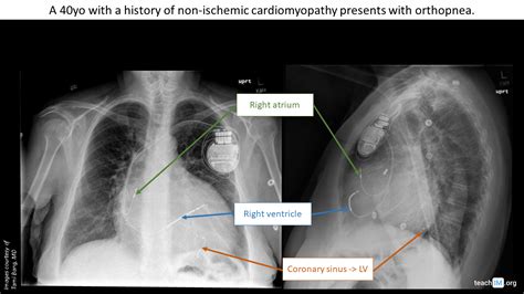 Pacemakers And Defibrillators Cxr Teachim