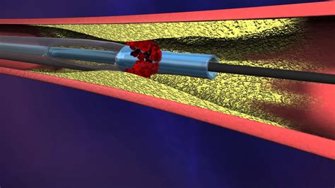 Aspire Mechanical Thrombectomy System Youtube