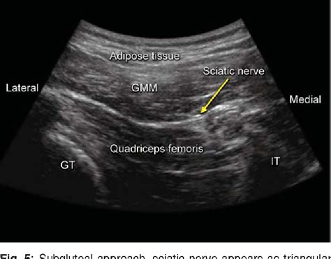 Figure From Ultrasound Guided Sciatic Nerve Block Posterior