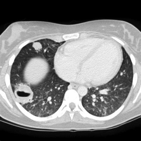 Lung mass imaging - wikidoc