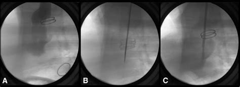 Angiographic Views Showing The Perforation Steps Of The Fontan