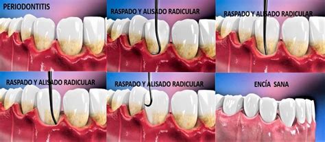 Raspado Y Alisado Radicular Tratamiento Periodontal BQDC