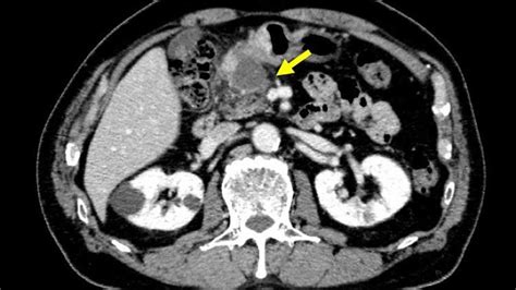 Abdominal Ct Showed The Tumor At The Gastric Antrum Visualized As A