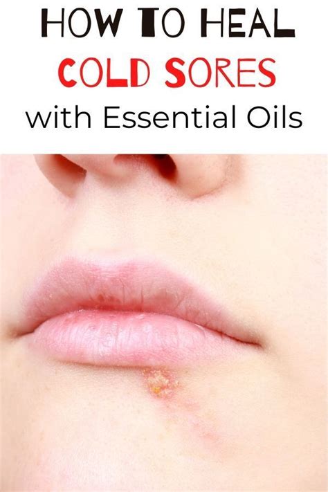 How To Stop And Heal Cold Sores With Essential Oils Cold Sore Essential Oil Healing Cold Sore