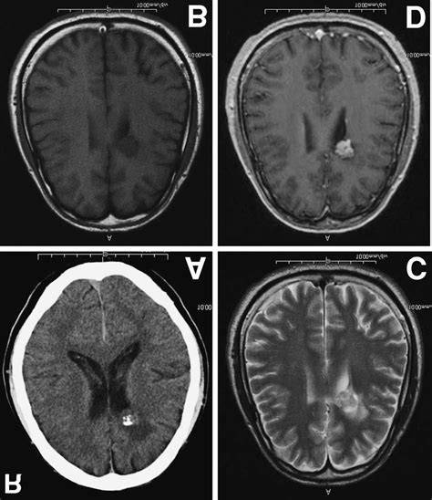 Radiological Findings Of Periventricular Schwannoma A Axial Cranial