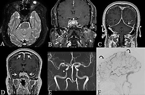 IgG4 Related Intracranial Disease Shahine Goulam Houssein Jeffrey L