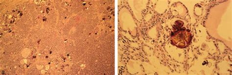 Psammoma Bodies In Fine‐needle Aspirates Of The Thyroid Ellison 1998 Cancer Cytopathology