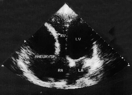 Two Dimensional Echocardiographic View Of The Right Atrial Aneurysm La